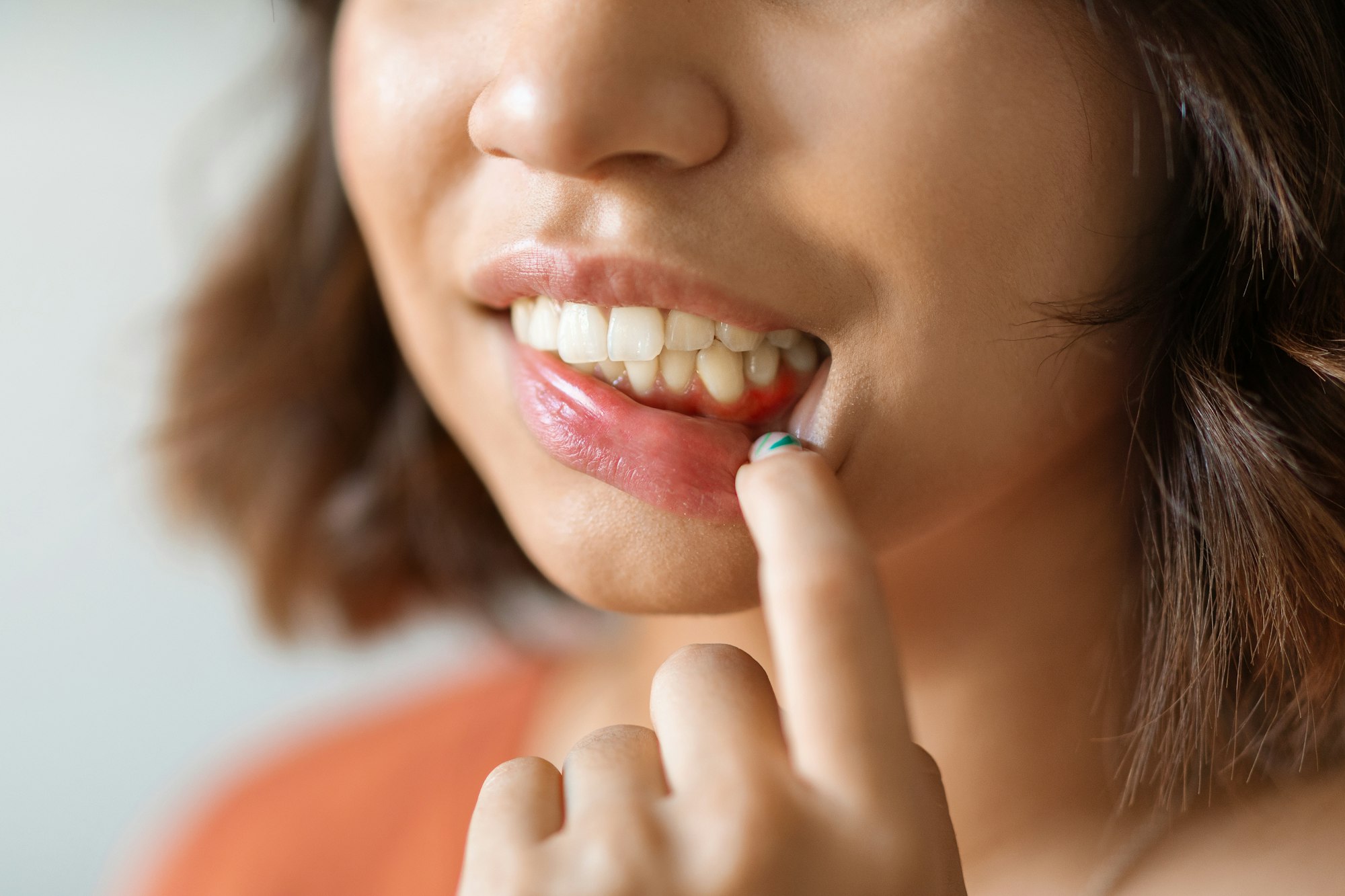 Woman pulling down her lip to reveal irritated, receding gums, highlighting the need for gum recession treatment at Shady Grove Periodontics in Rockville, MD.